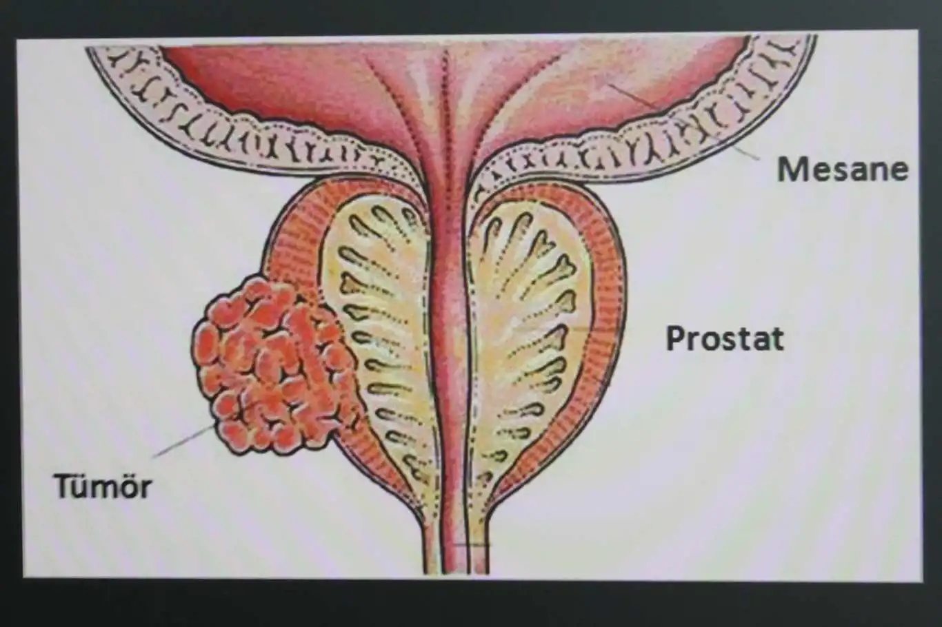 Prostat kanseri nedir ve belirtileri nelerdir?