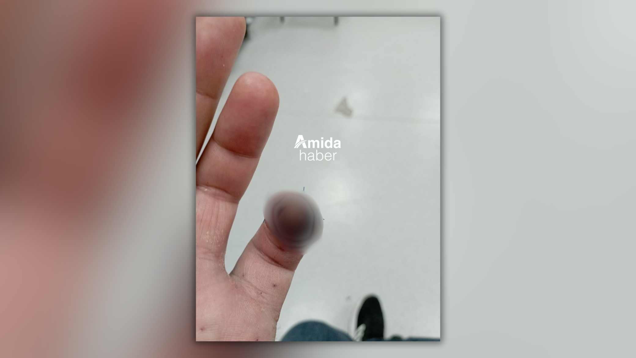 Diyarbakır: Tedavi için gitti, parmağından oldu