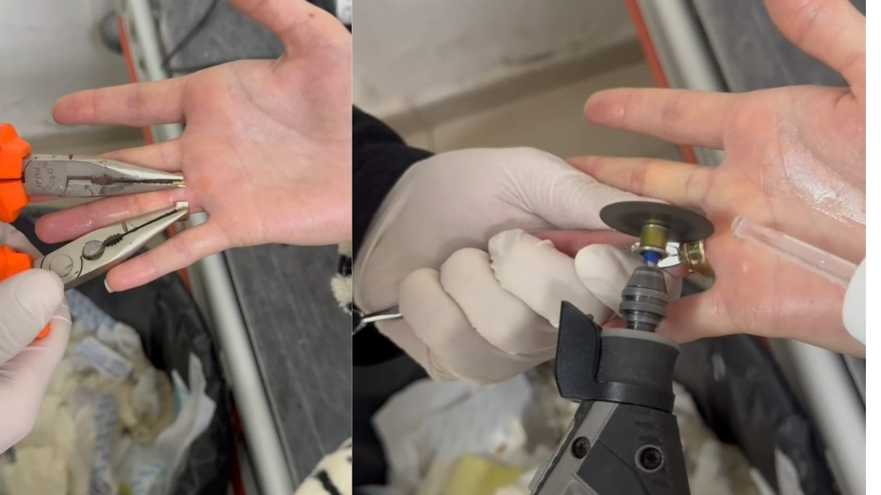 Batman'da parmağa sıkışan yüzükler 'spiral makine' ile çıkarıldı