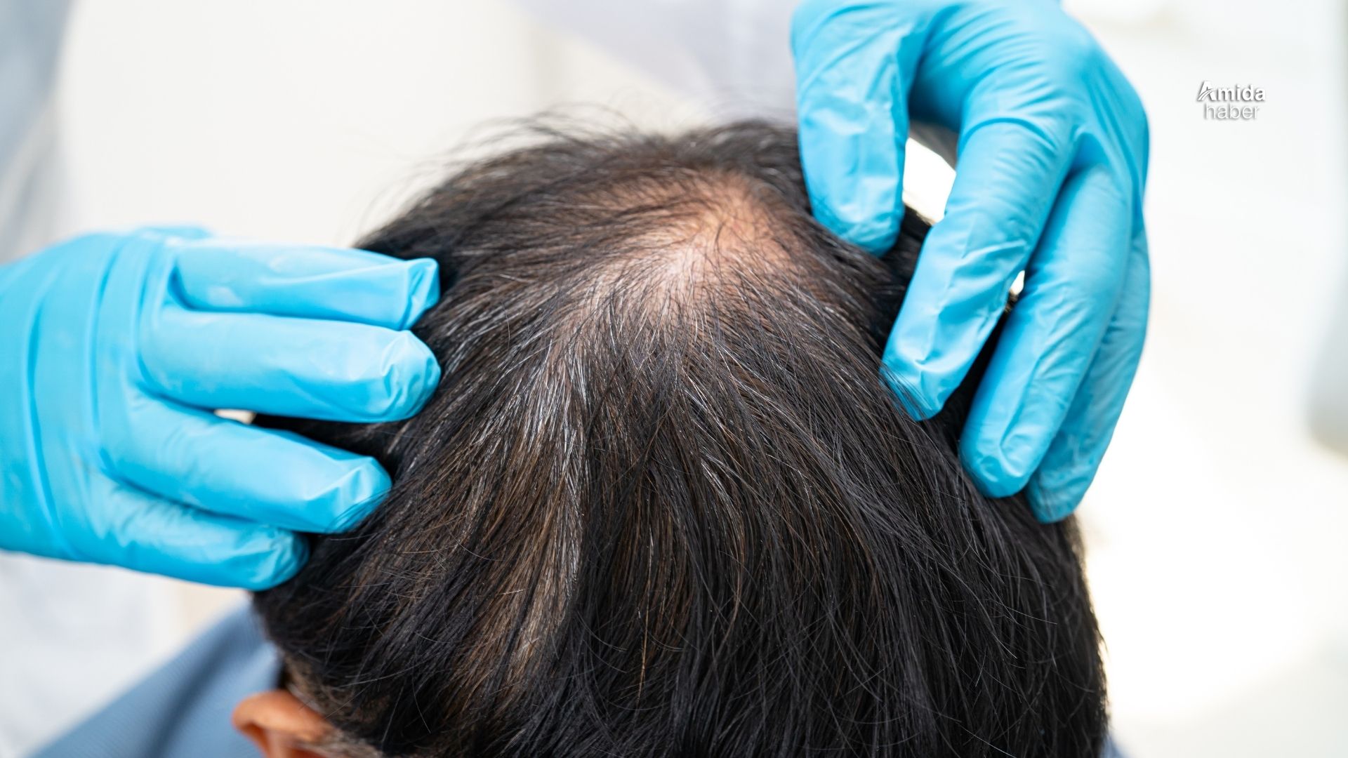 Haber Amerika’dan: Kelliğe çare bulundu