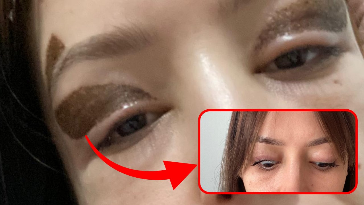 Diyarbakır’da estetik faciası: Gözünden oldu