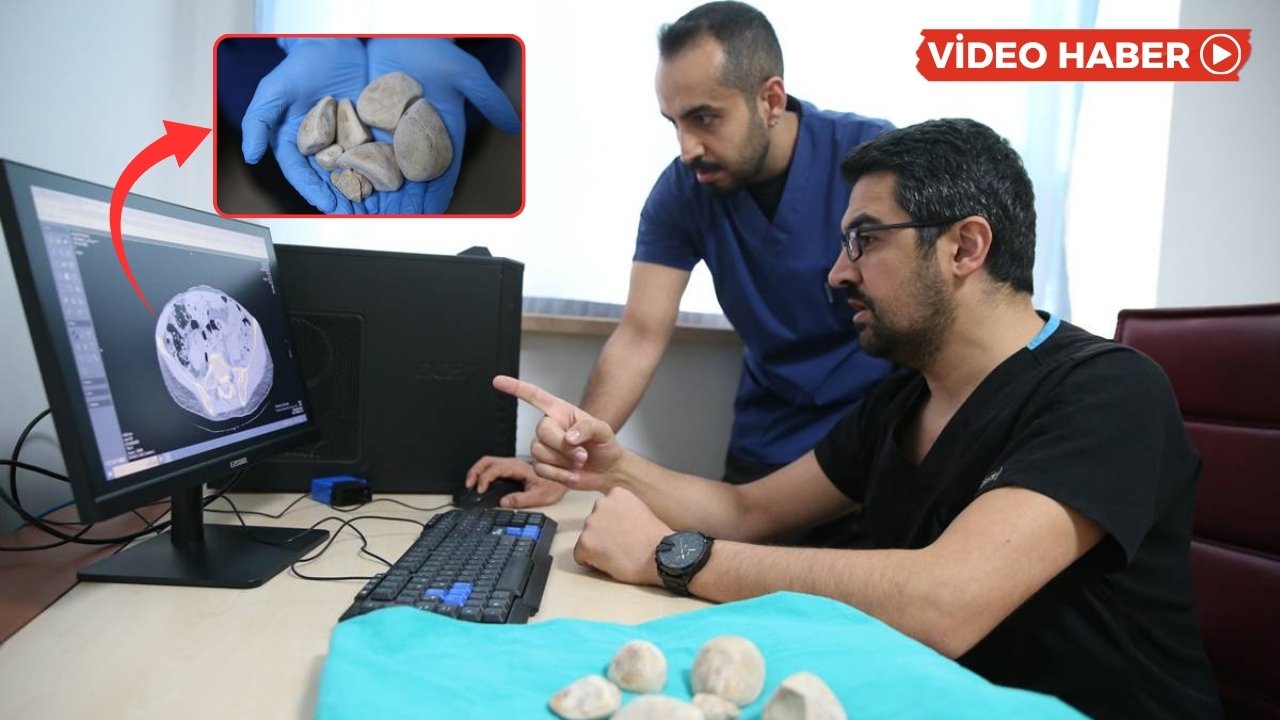 Diyarbakır’da hastanın mesanesinden yarım kilo taş çıktı