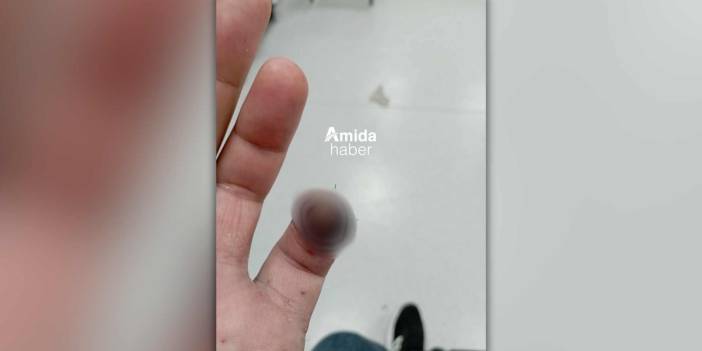 Diyarbakır: Tedavi için gitti, parmağından oldu
