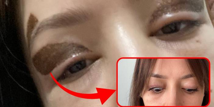 Diyarbakır’da estetik faciası: Gözünden oldu